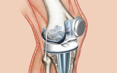Total Knee Replacement