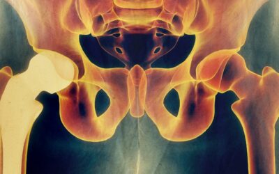 Hip Replacement Surgery