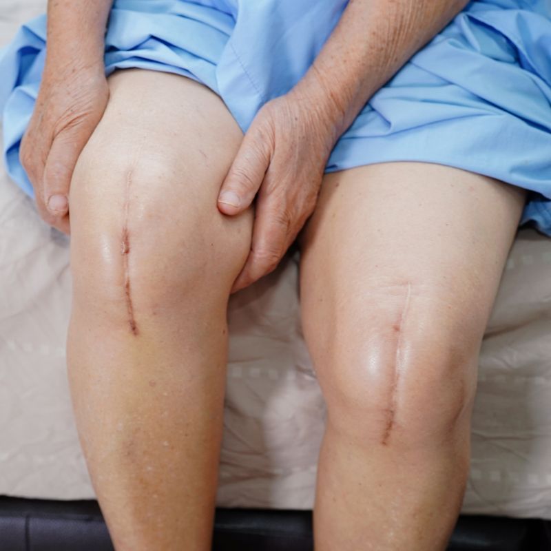 Total Knee Replacements